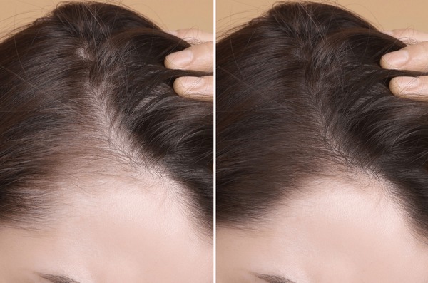 Before And After Comparison Of A Woman'S Hairline Showing Improved Density Following A Micro-Channeling Scalp Nyc Advance Scalp Infusion Series.
