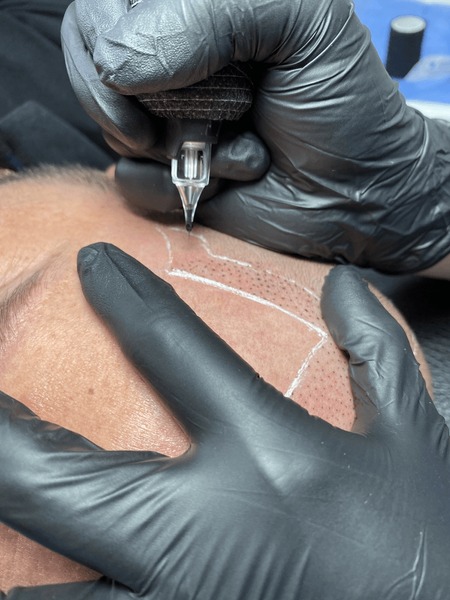 An Scalp Micropigmentation Artist Outlining A New Hairline Restoration Smp Design On A Patient'S Scalp Before The Procedure.
