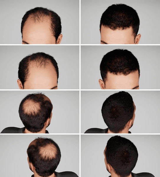 Before And After Hair Transplant Results Showing Significant Hair Regrowth And Restored Hairline From Front And Back Views Over Multiple Treatment Stages.